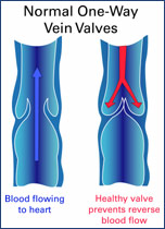 Diagram showing normal one-way vein valves allowing blood to flow toward the heart and preventing reverse blood flow