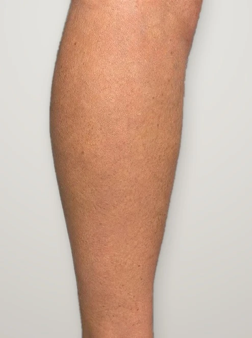 After treatment: bulging varicose veins on the calf