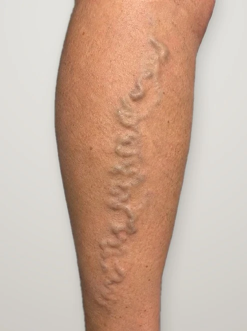 Before treatment: bulging varicose veins on the calf