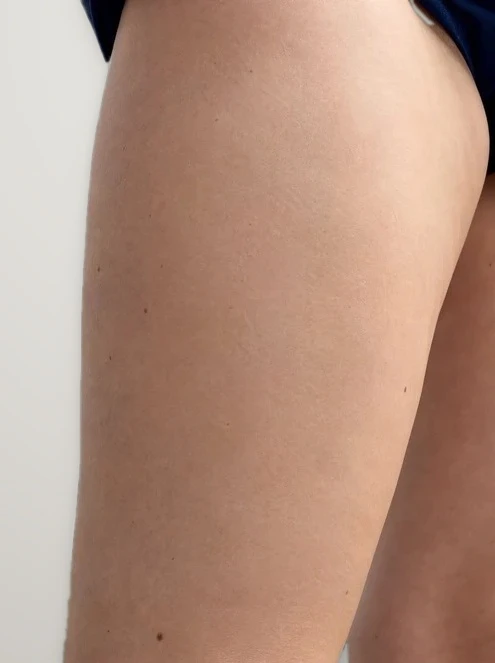 After treatment: varicose veins on the back of the thigh