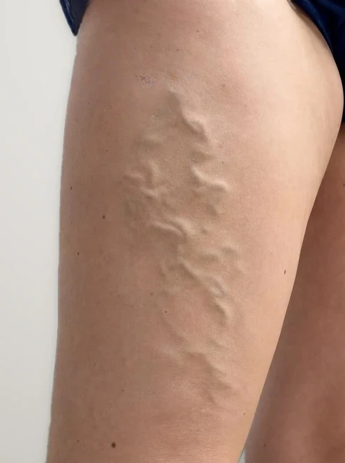 Before treatment: varicose veins on the back of the thigh