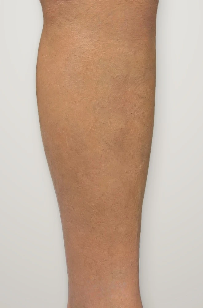 After treatment: large varicose veins on the calf