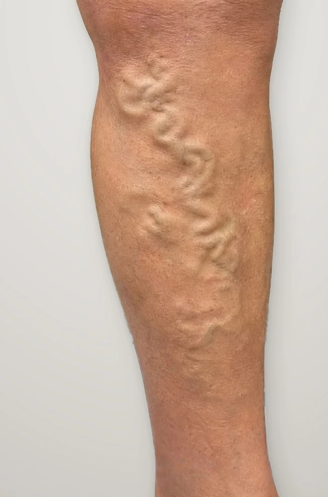 Before treatment: large varicose veins on the calf