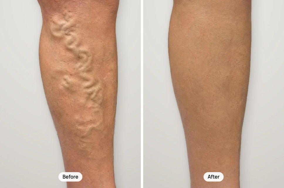 Before and after treatment: large varicose veins on the calf