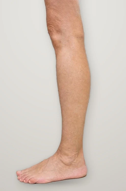 After treatment: varicose veins along the inner leg
