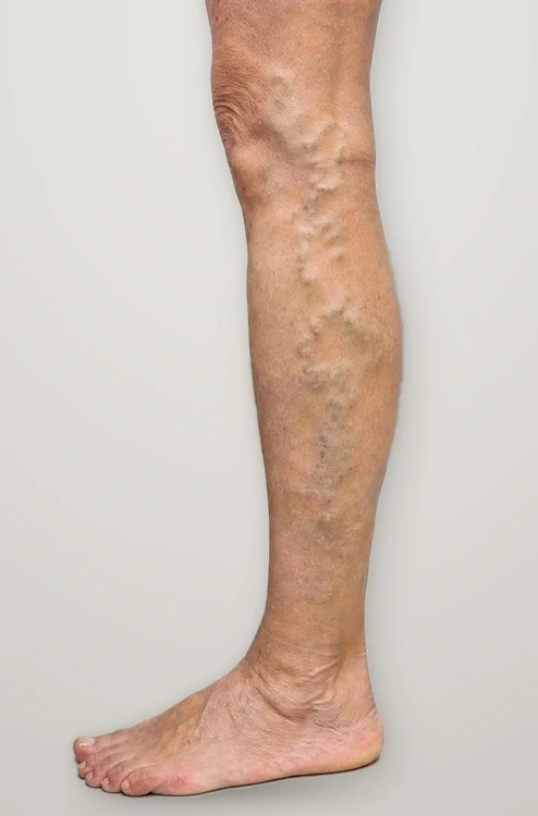 Before treatment: varicose veins along the inner leg