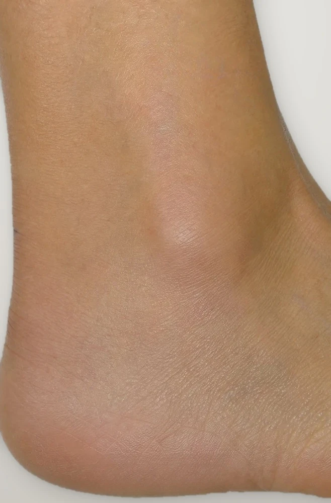 After treatment: spider veins around the ankle