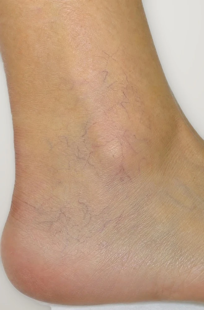 Before treatment: spider veins around the ankle
