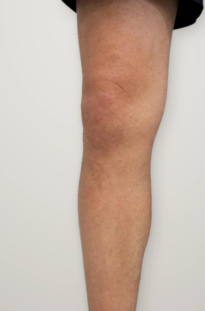 After treatment: varicose veins from the knee down the calf