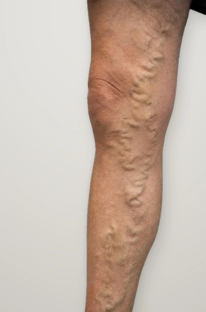 Before treatment: varicose veins from the knee down the calf