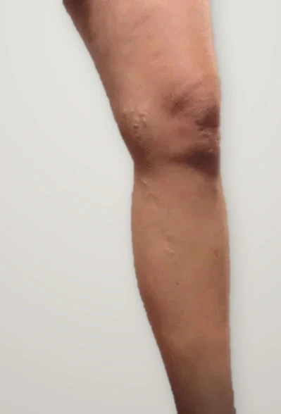 After treatment: a bulging varicose vein behind the knee