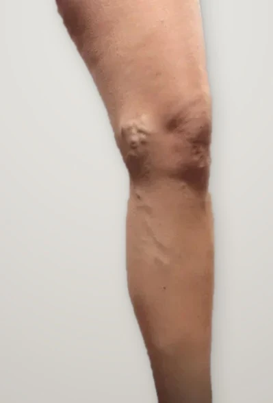 Before treatment: a bulging varicose vein behind the knee