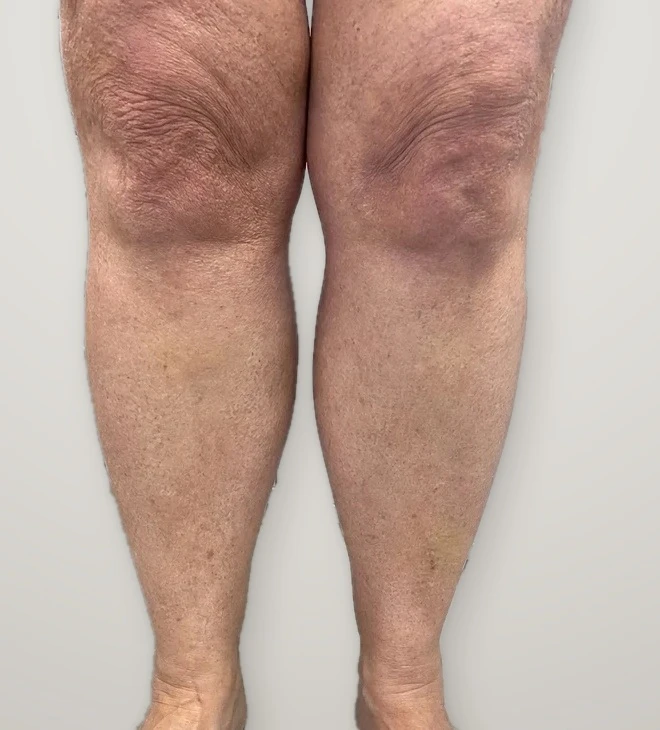 After treatment: varicose veins on both knees and shins