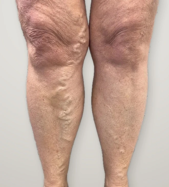 Before treatment: varicose veins on both knees and shins