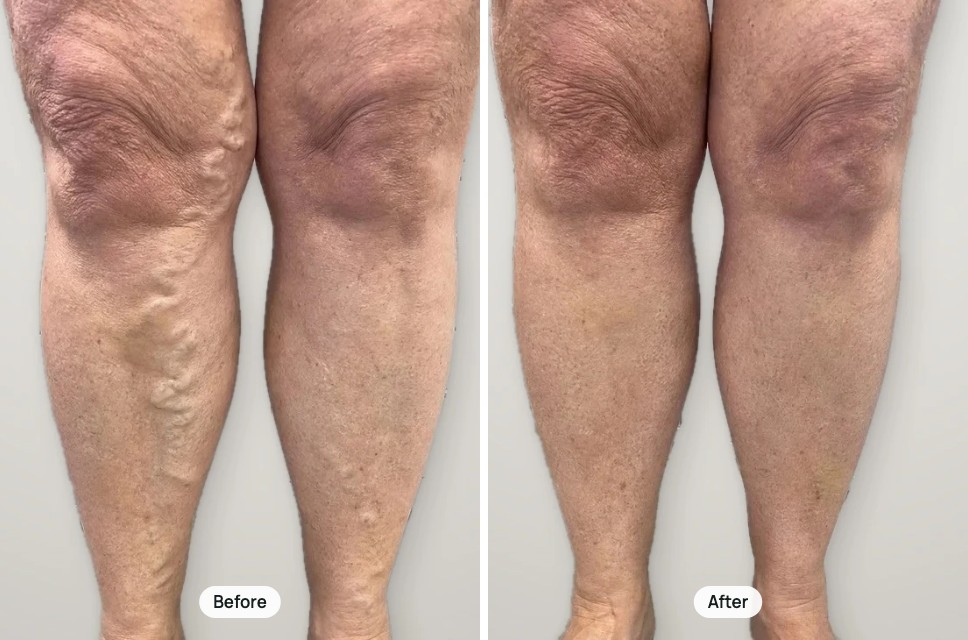 Before and after treatment: varicose veins on both knees and shins