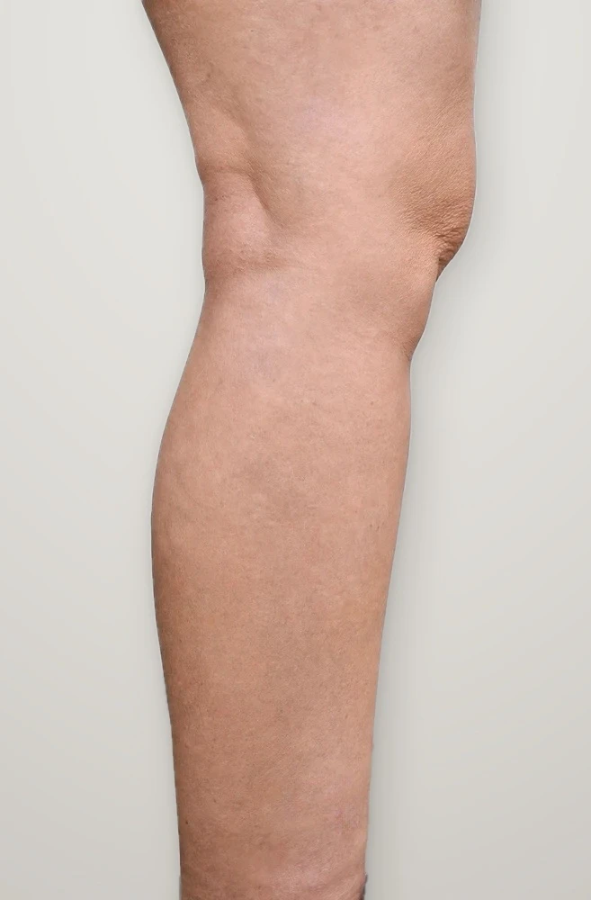 After treatment: varicose veins on the inner calf