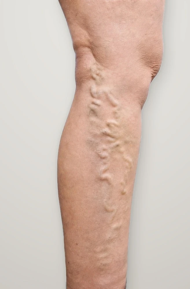 Before treatment: varicose veins on the inner calf