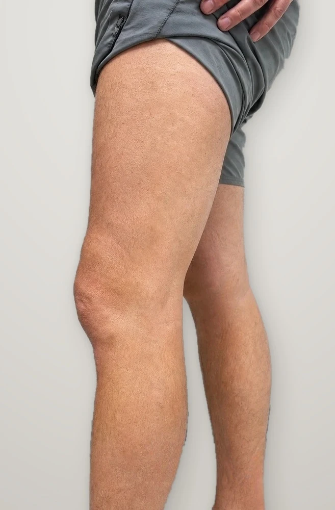 After treatment: varicose veins on the thigh and knee