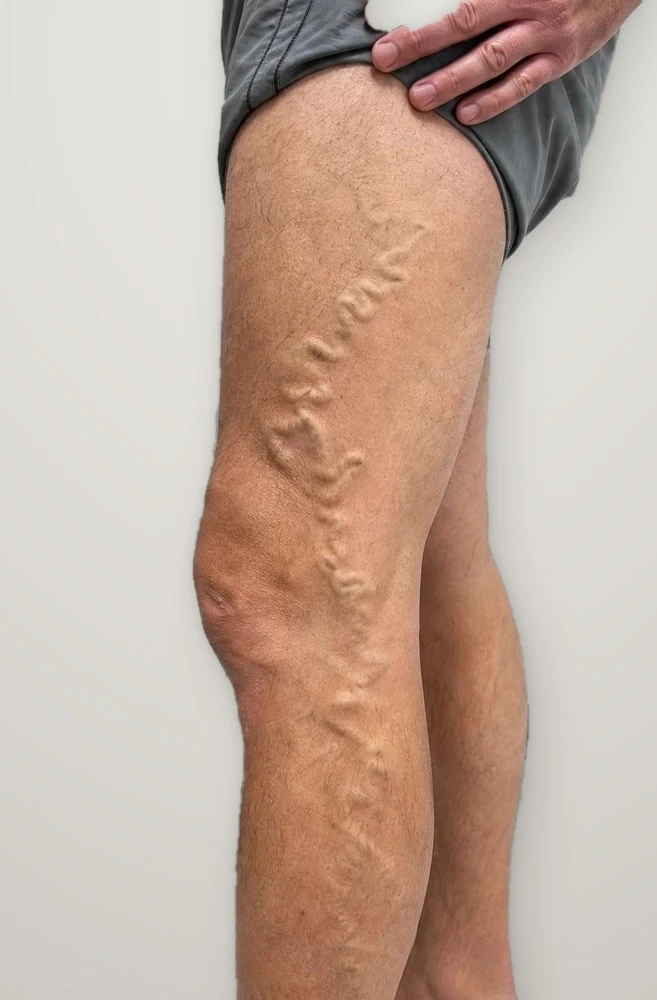 Before treatment: varicose veins on the thigh and knee