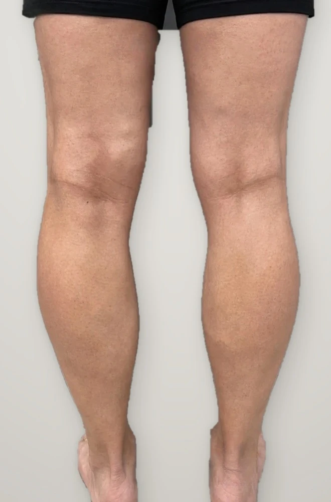After treatment: varicose veins on the backs of both legs