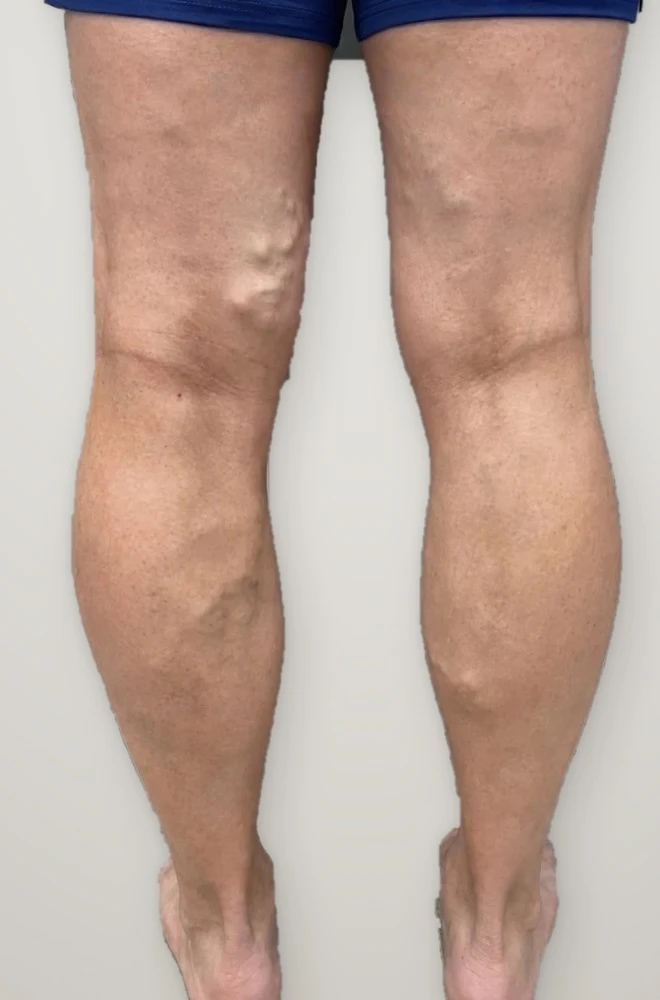 Before treatment: varicose veins on the backs of both legs