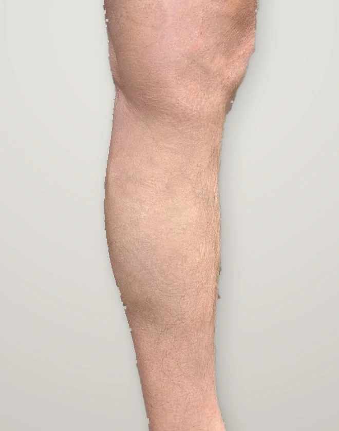 After treatment: varicose veins on the calf