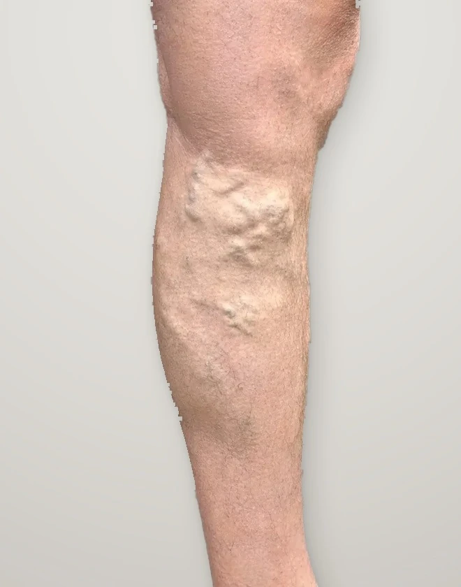 Before treatment: varicose veins on the calf