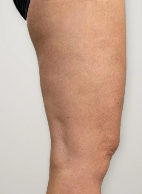 After treatment: varicose veins on the outer thigh