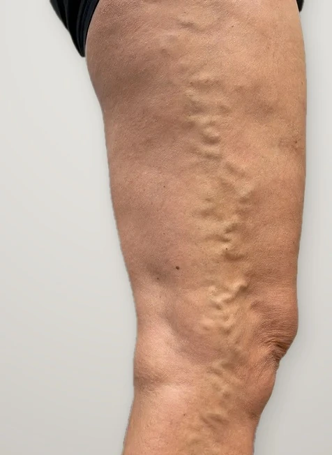 Before treatment: varicose veins on the outer thigh