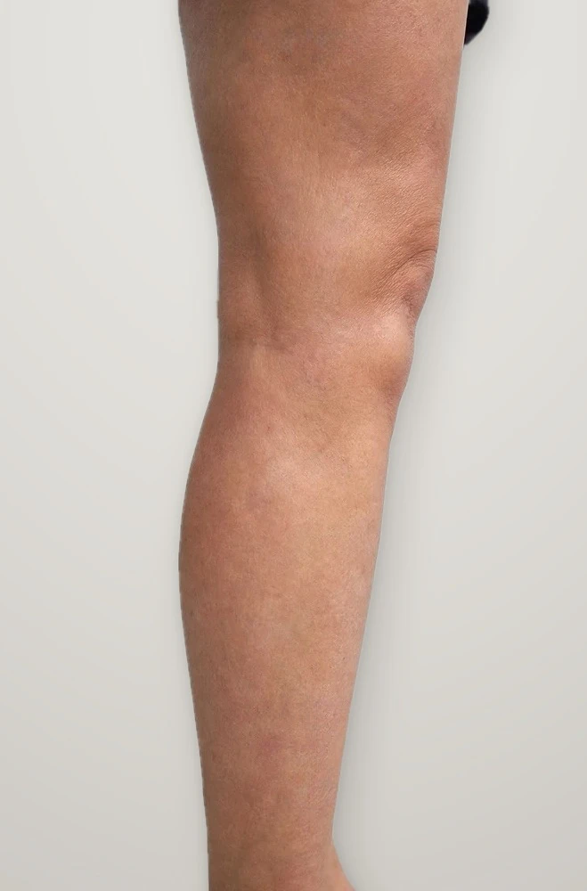 After treatment: varicose veins on the back of the leg
