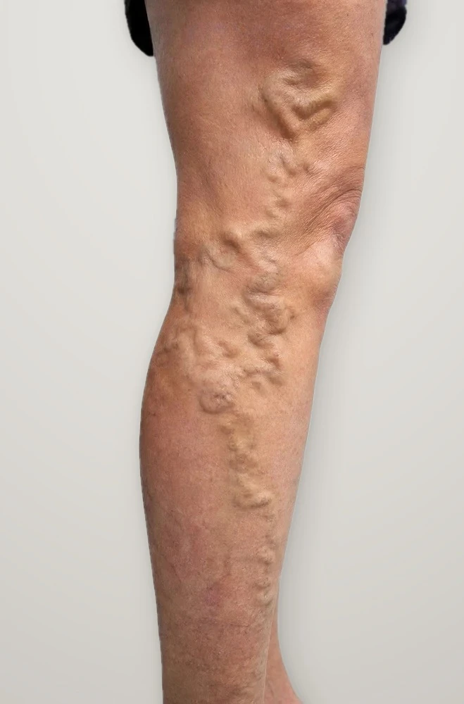 Before treatment: varicose veins on the back of the leg