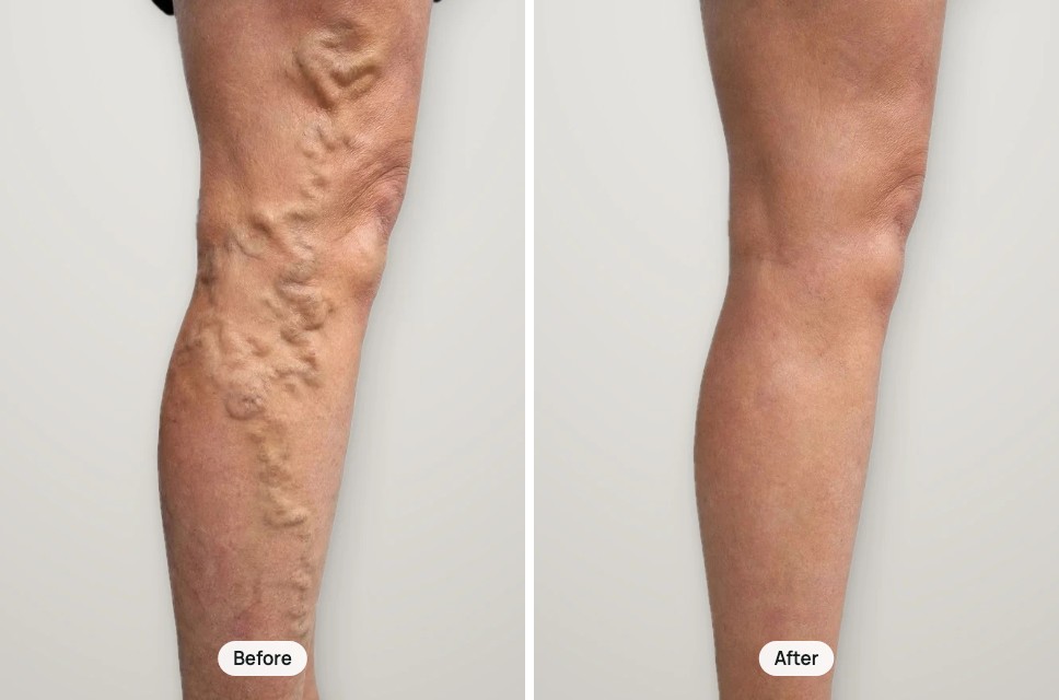 Before and after treatment: varicose veins on the back of the leg