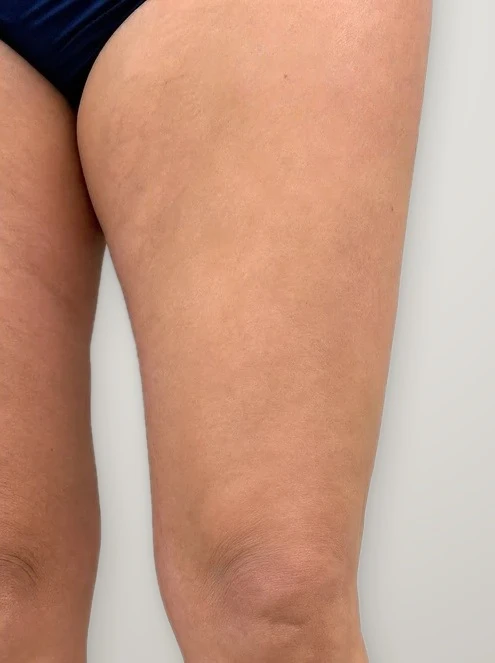 After treatment: varicose veins on the inner thigh