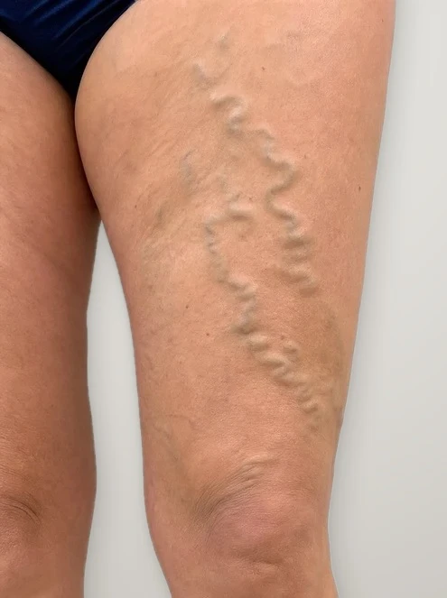 Before treatment: varicose veins on the inner thigh