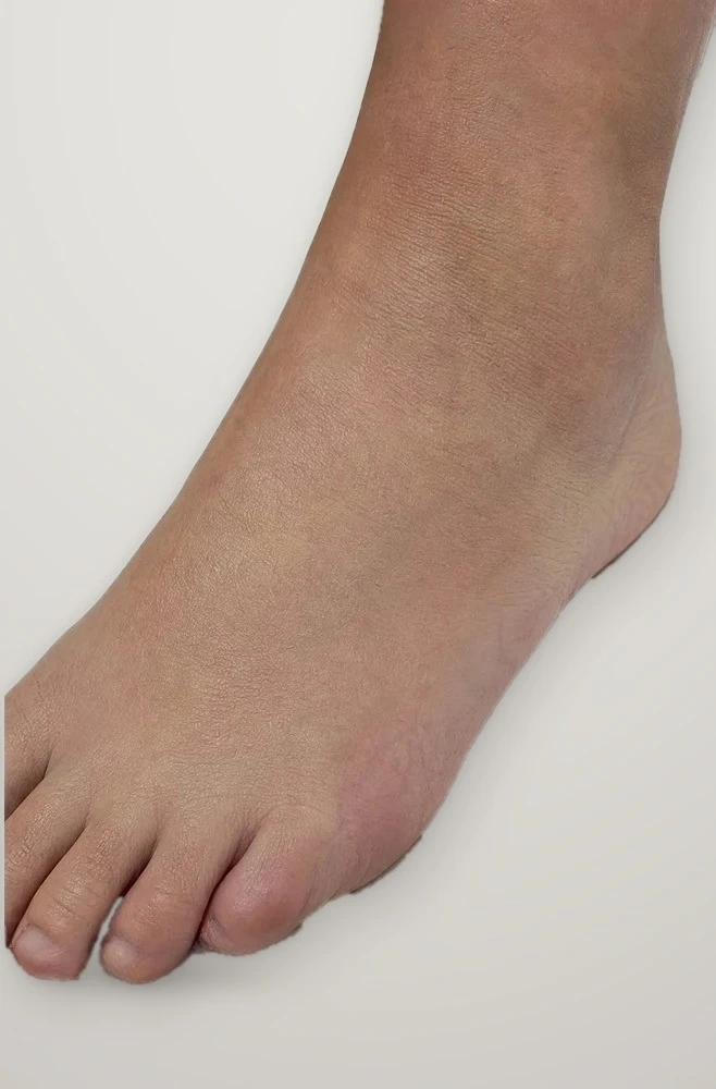 After treatment: spider veins on the top of the foot