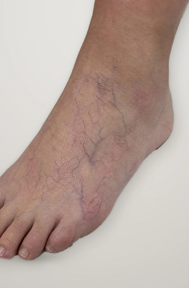 Before treatment: spider veins on the top of the foot