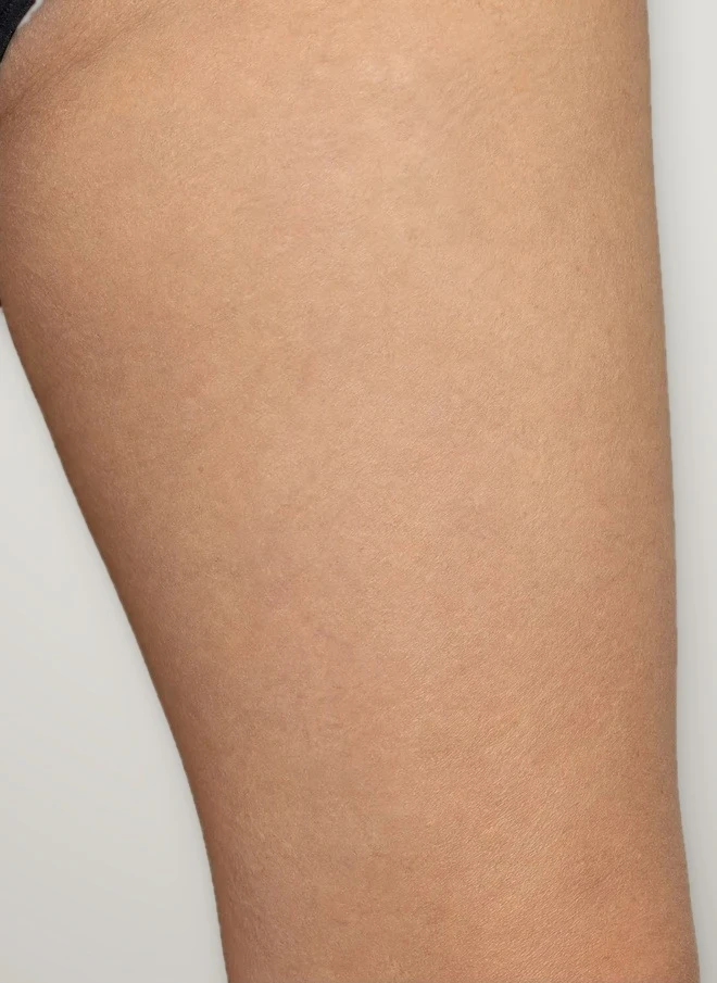 After treatment: spider and reticular veins on the thigh