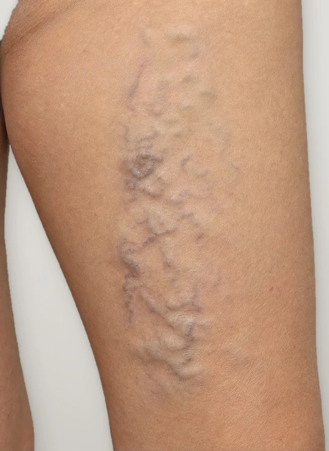 Before treatment: spider and reticular veins on the thigh