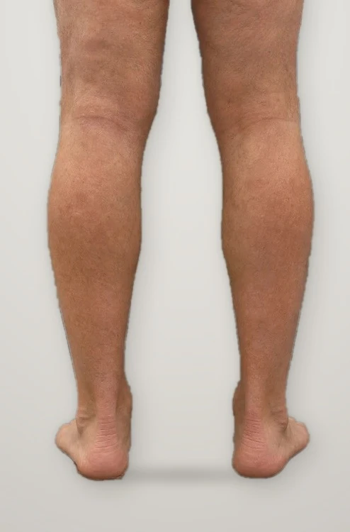 After treatment: varicose veins on both calves