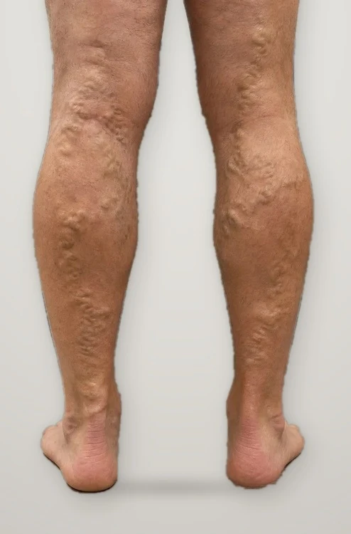 Before treatment: varicose veins on both calves