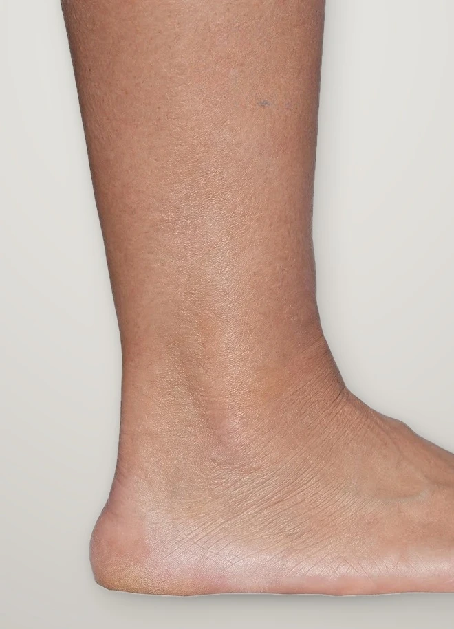 After treatment: spider veins around the inner ankle