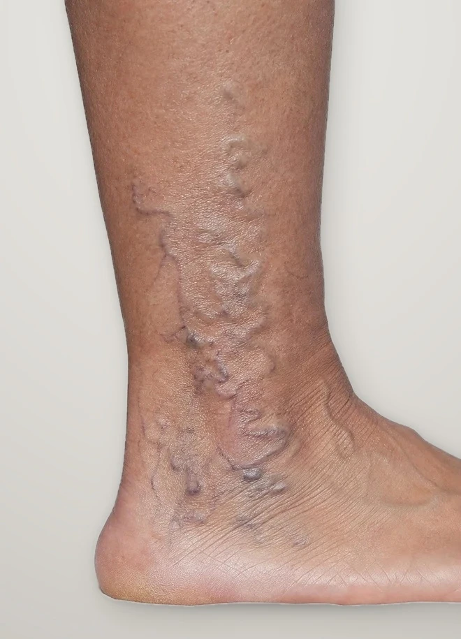 Before treatment: spider veins around the inner ankle