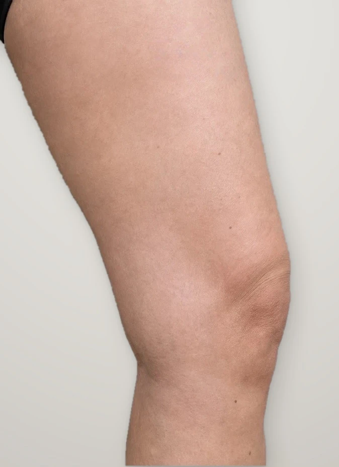 After treatment: varicose veins on the thigh above the knee