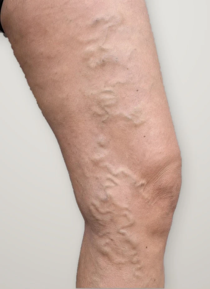 Before treatment: varicose veins on the thigh above the knee