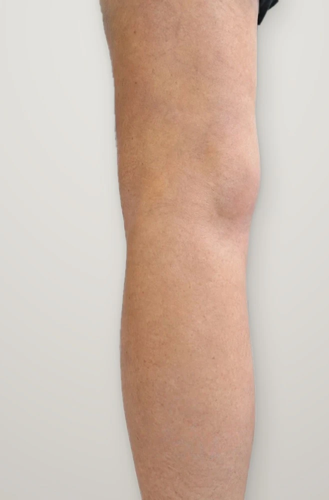 After treatment: varicose veins on the back of the leg