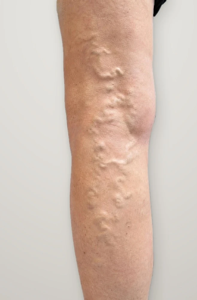 Before treatment: varicose veins on the back of the leg